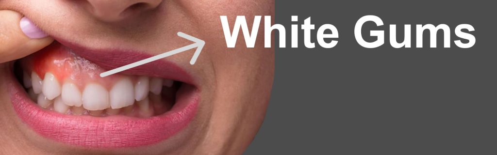 White-Gums-And-Causes White Gums