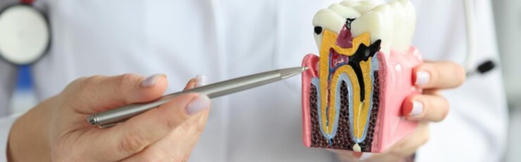 root canal recovery root canal recovery
