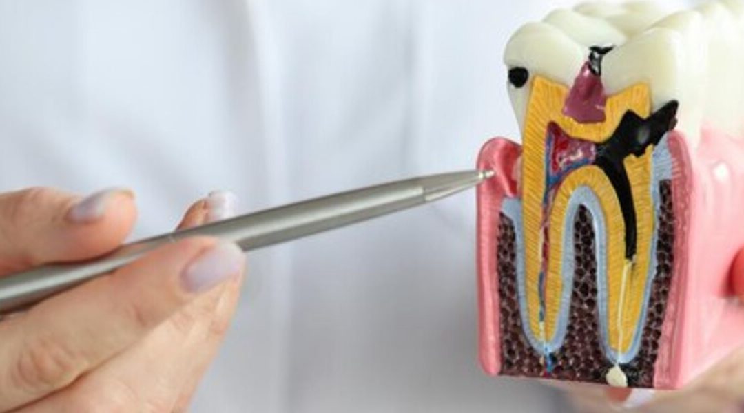 Root Canal Recovery: What to Expect and How to Heal Properly