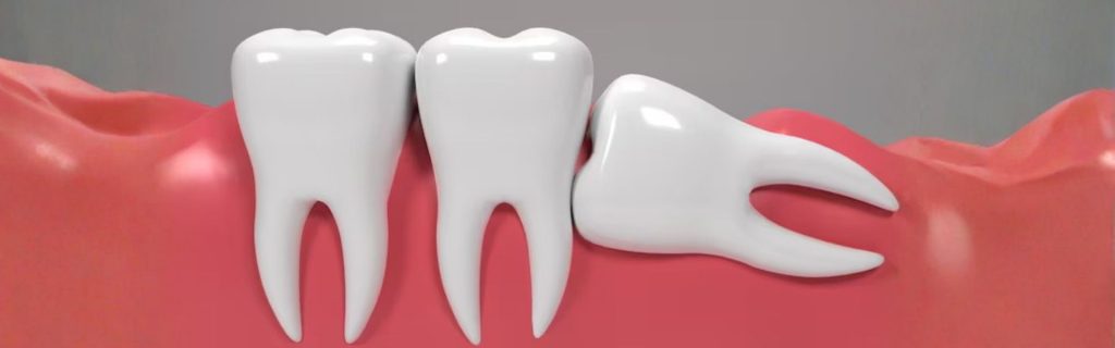 Does everyone have wisdom teeth