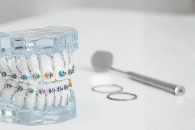 Traditional Braces 