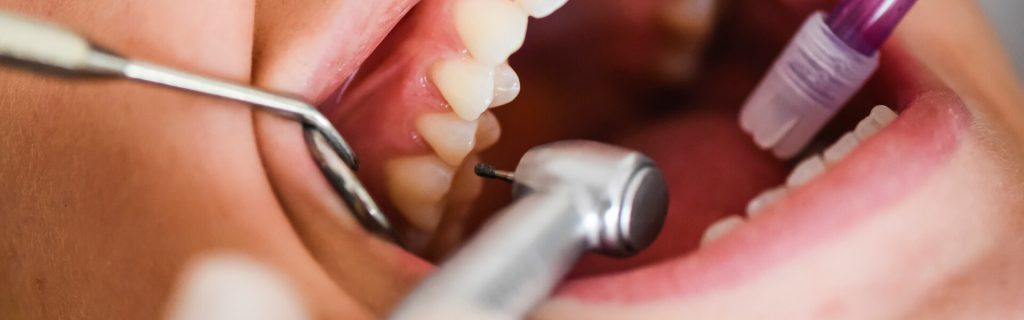 Is My Tooth Turning Black? 5 Signs It’s an Emergency