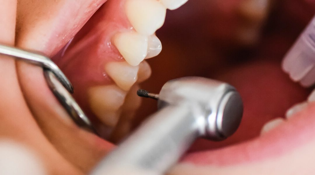 Black Teeth| Symptoms, Causes, and Treatment