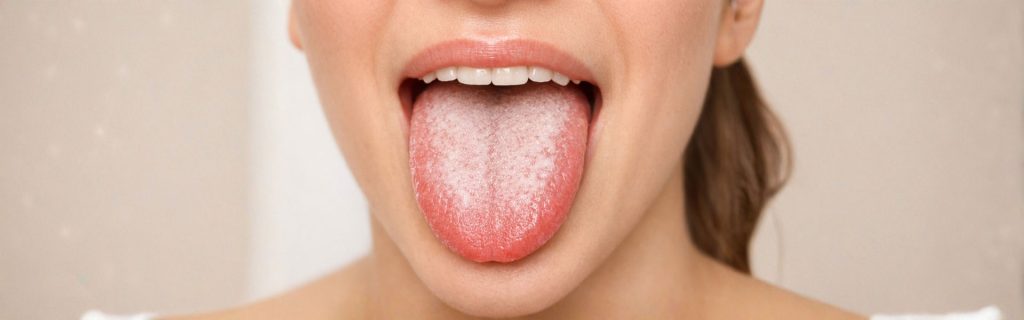 white tongue