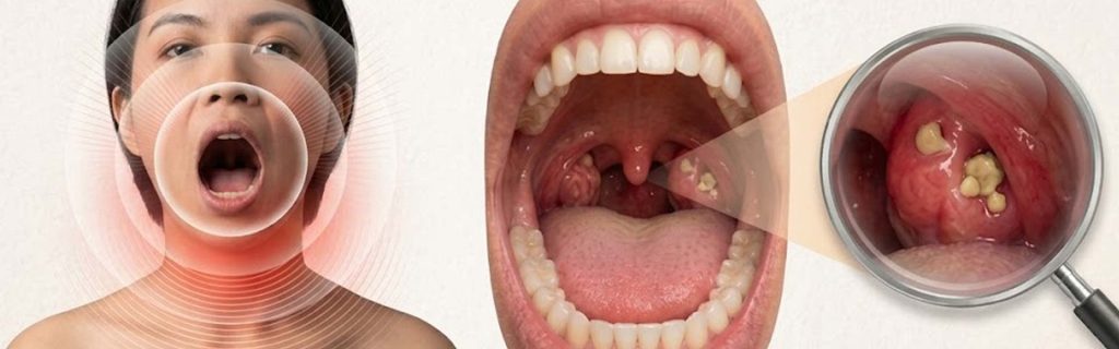 Tonsil Stones