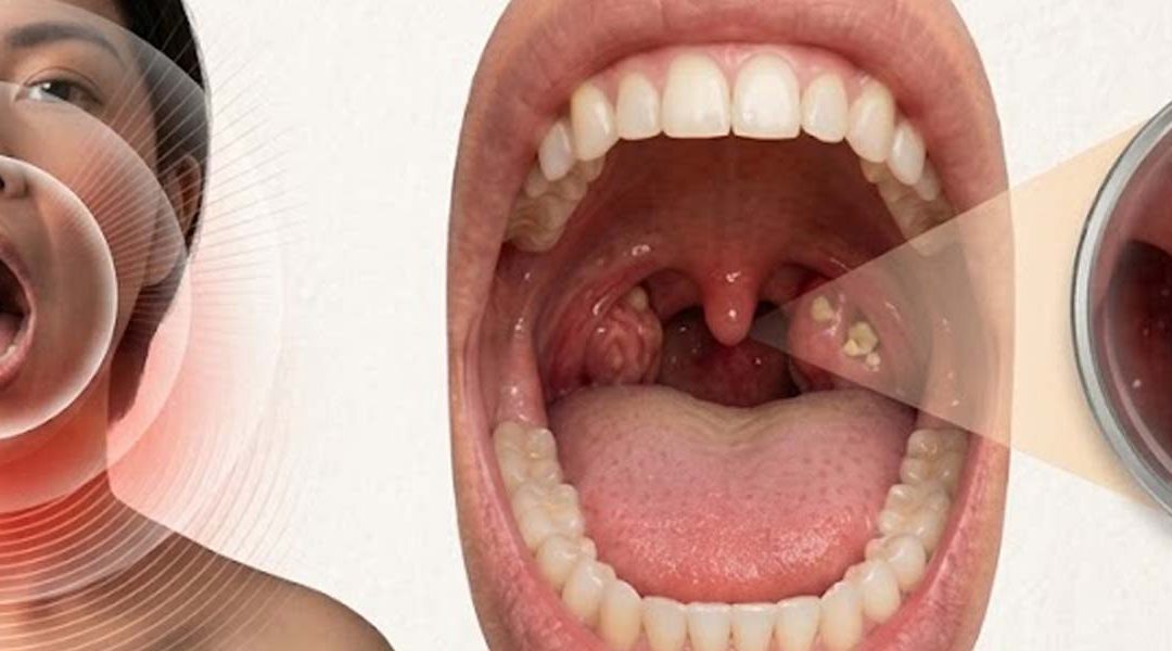 How to Safely Remove Tonsil Stones?