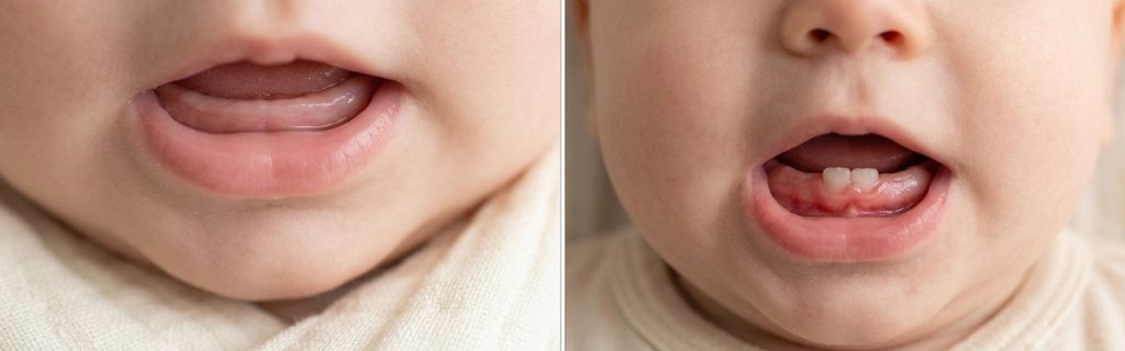 Normal-Baby-Gums-vs-Teething-Gums