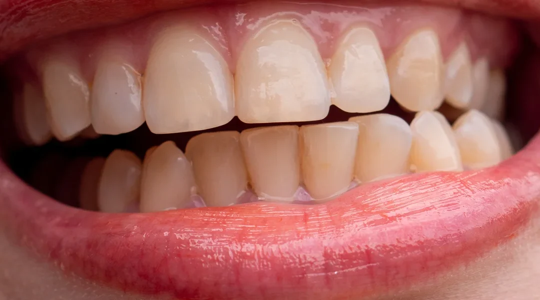 Why Are My Teeth Yellow When I Brush Them Every Day?