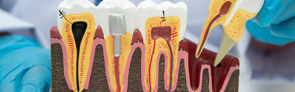 Healing-Normal-Socket-After-Tooth-Extraction