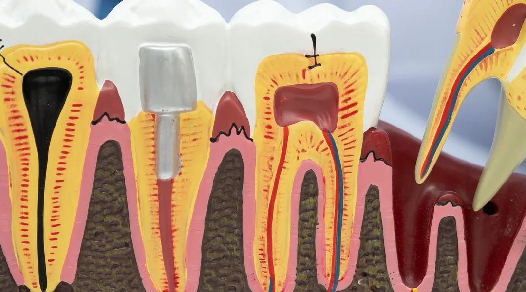 Healing Normal Socket After Tooth Extraction