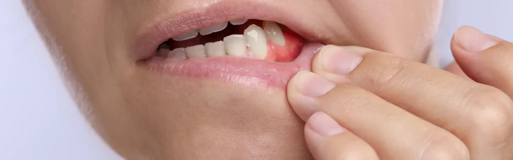 My-Gum-Swollen-Around-One-Tooth-in-the-Back