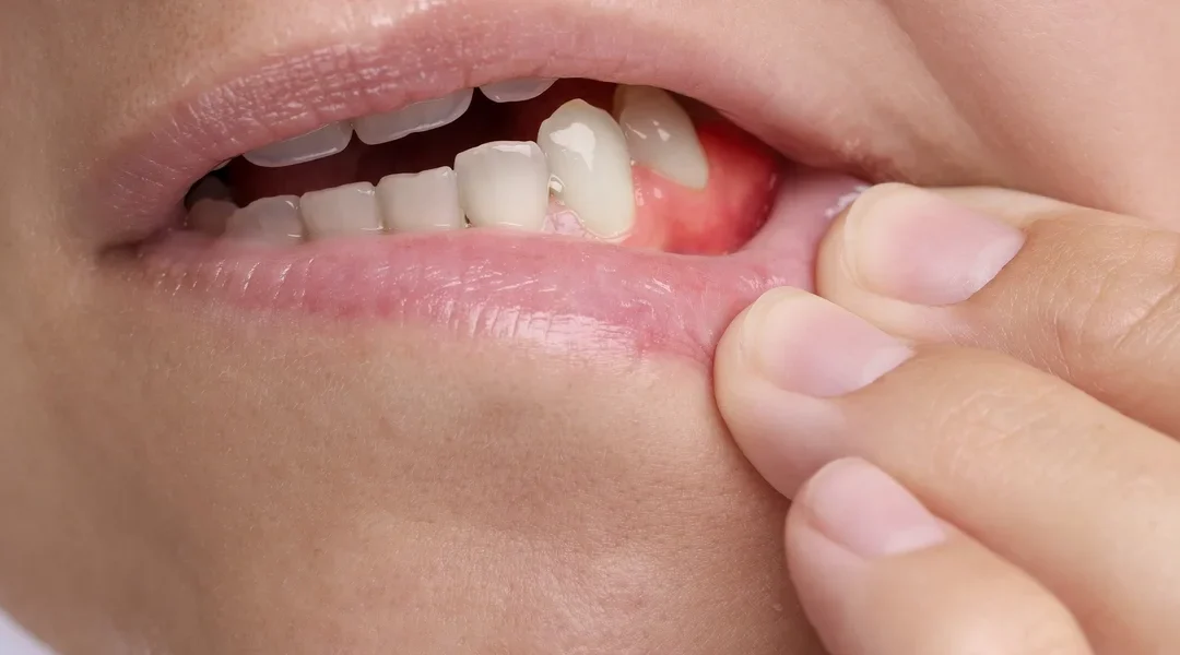 Why Is My Gum Swollen Around One Tooth in the Back?